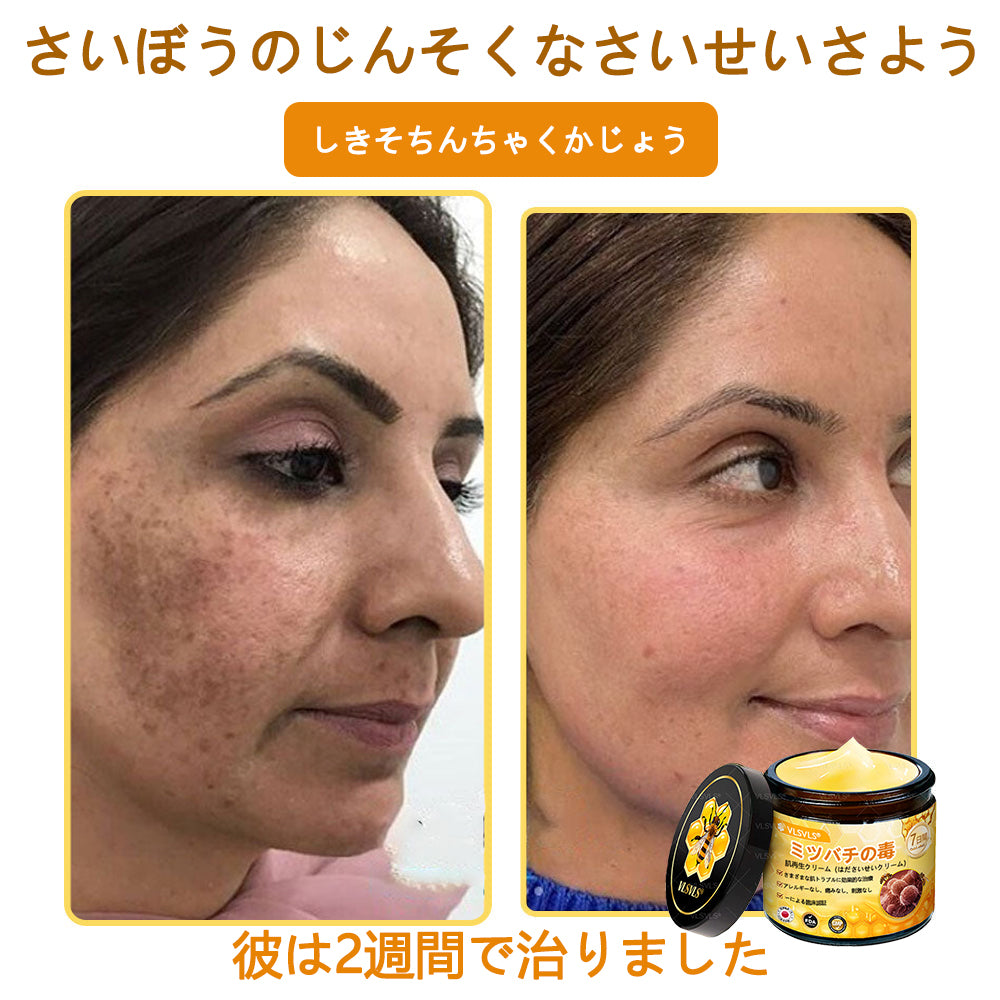 VLSVLS™ 蜂毒配合スキンクリーム（フルケアタイプ）🧑‍⚕️ 皮膚科医も推薦！ 肌トラブル全般に対応した高機能クリームです