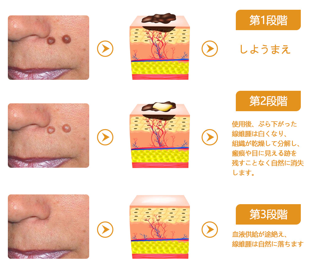 🐝アメリカ製🇺🇸【代引きOK】Twinsun™超高濃度ビーベノム（蜂毒）配合クリーム！ 💖FDA認可取得済みの安心処方で、いぼ・皮膚の盛り上がり・感染・角化症、そしてゴワついた肌のケアにぴったり！
