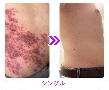 Bikenda® 高性能CO₂レーザーペン 🛫（痛みなし・面倒なしで、イボ・ほくろ・シミ・小さな肌のふくらみをやさしく除去！）お肌のケアにおすすめの非侵襲的アイテムだよ！