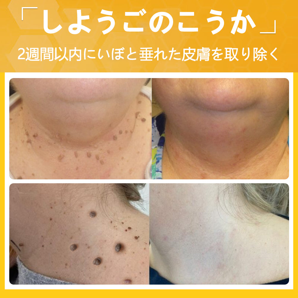 🐝アメリカ製🇺🇸【代引きOK】Twinsun™超高濃度ビーベノム（蜂毒）配合クリーム！ 💖FDA認可取得済みの安心処方で、いぼ・皮膚の盛り上がり・感染・角化症、そしてゴワついた肌のケアにぴったり！