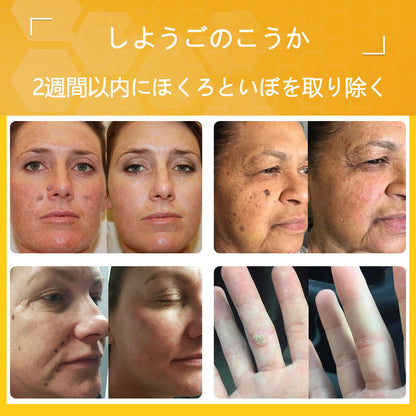 🐝アメリカ製🇺🇸【代引きOK】Twinsun™超高濃度ビーベノム（蜂毒）配合クリーム！ 💖FDA認可取得済みの安心処方で、いぼ・皮膚の盛り上がり・感染・角化症、そしてゴワついた肌のケアにぴったり！