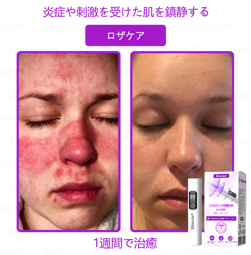 Bikenda® 高性能CO₂レーザーペン 🛫（痛みなし・面倒なしで、イボ・ほくろ・シミ・小さな肌のふくらみをやさしく除去！）お肌のケアにおすすめの非侵襲的アイテムだよ！