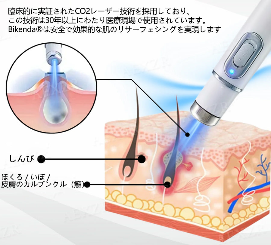 [代金引換] Bikenda® 非侵襲型レーザーペン 自宅で安全にシミ・イボを除去できる最新アイテム！💎