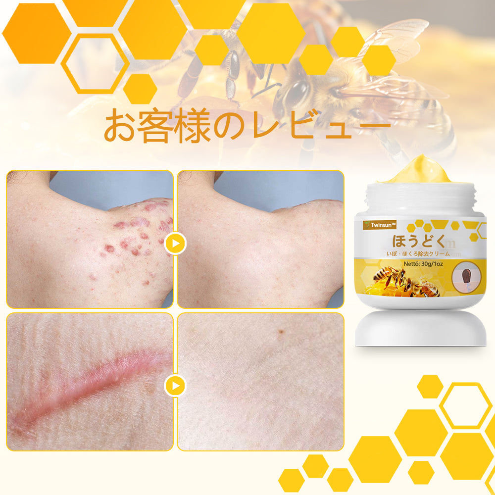 🐝アメリカ製🇺🇸【代引きOK】Twinsun™超高濃度ビーベノム（蜂毒）配合クリーム！ 💖FDA認可取得済みの安心処方で、いぼ・皮膚の盛り上がり・感染・角化症、そしてゴワついた肌のケアにぴったり！